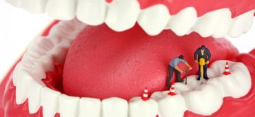 عصب کشی (درمان ریشه) دندان چیست؟