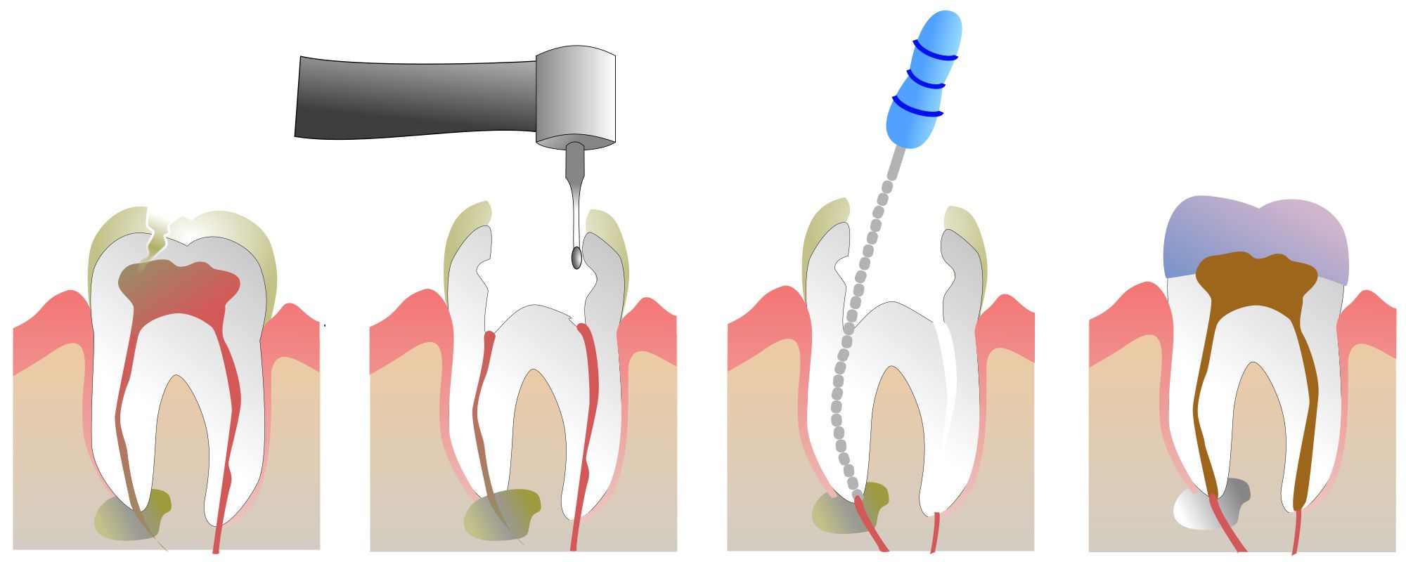 عصب کشی دندان چیست