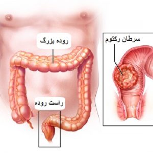 سرطان رکتوم یا راست روده