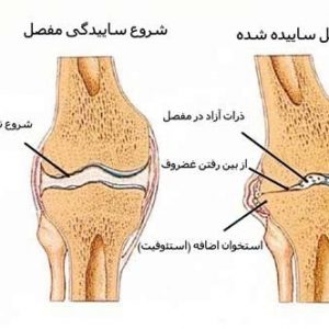 علت آرتروز یا ساییدگی مفصل