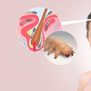 انگل دمودکس عامل ریزش موی سر