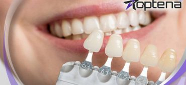 ۷ علت تغییر رنگ کامپوزیت دندان