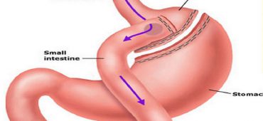 راهنمای کامل رژیم غذایی بعد از جراحی بای پس معده